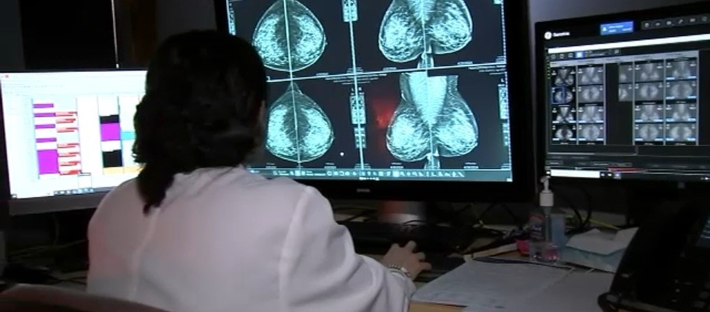 New breast cancer screening guidelines